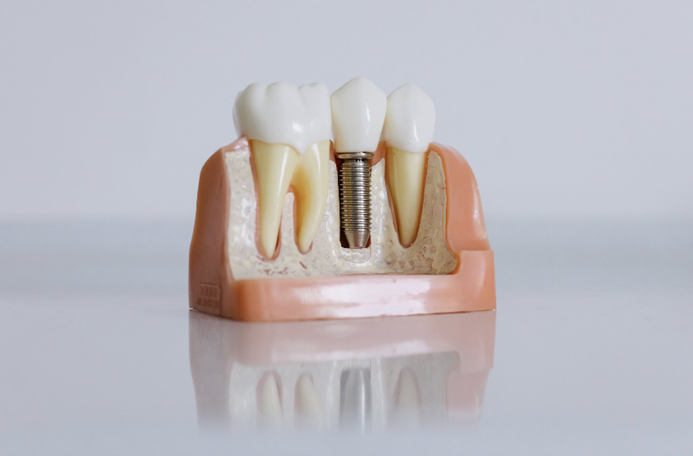 The Role of Dental Implants in Periodontics